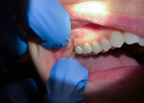 Best Root Canal Emergency Dentist  in Boerne, TX